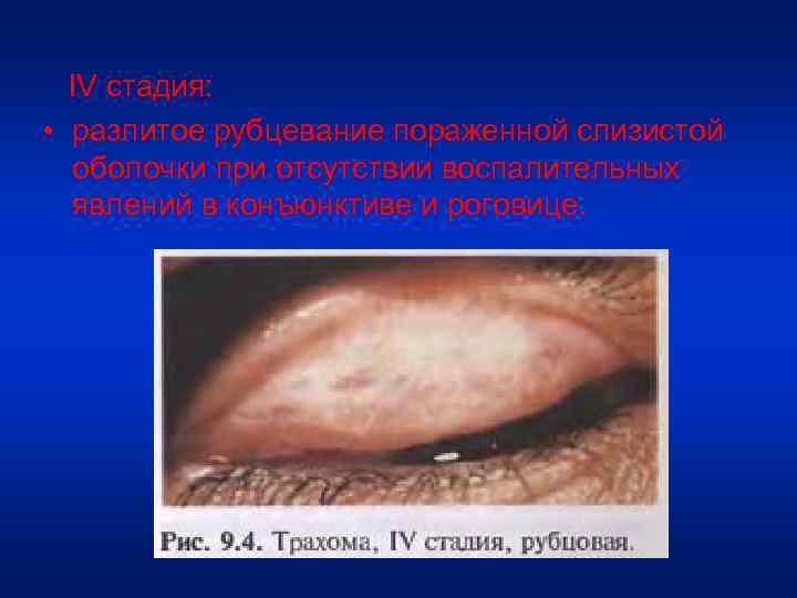  IV стадия: • разлитое рубцевание пораженной слизистой оболочки при отсутствии воспалительных явлений в