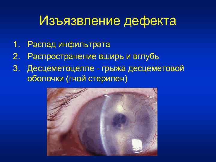 Изъязвление дефекта 1. Распад инфильтрата 2. Распространение вширь и вглубь 3. Десцеметоцелле - грыжа