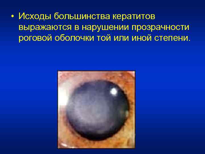  • Исходы большинства кератитов выражаются в нарушении прозрачности роговой оболочки той или иной