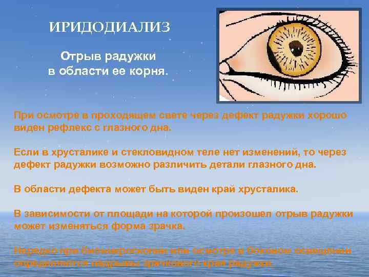 ИРИДОДИАЛИЗ Отрыв радужки в области ее корня. При осмотре в проходящем свете через дефект