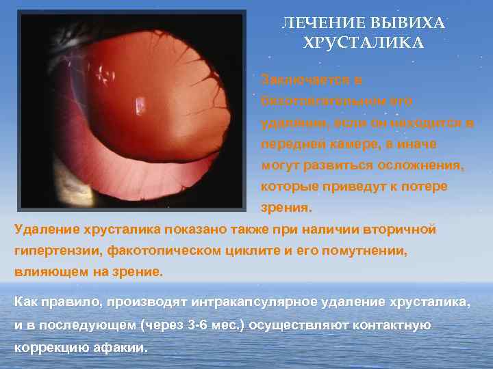 ЛЕЧЕНИЕ ВЫВИХА ХРУСТАЛИКА Заключается в безотлагательном его удалении, если он находится в передней камере,