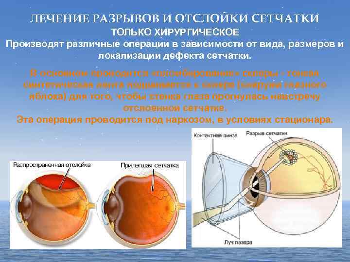 ЛЕЧЕНИЕ РАЗРЫВОВ И ОТСЛОЙКИ СЕТЧАТКИ ТОЛЬКО ХИРУРГИЧЕСКОЕ Производят различные операции в зависимости от вида,