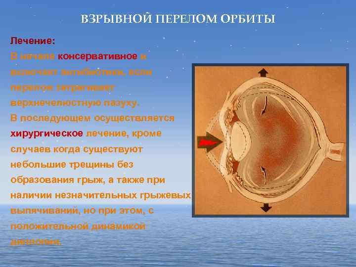 ВЗРЫВНОЙ ПЕРЕЛОМ ОРБИТЫ Лечение: В начале консервативное и включает антибиотики, если перелом затрагивает верхнечелюстную