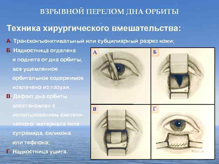 ВЗРЫВНОЙ ПЕРЕЛОМ ДНА ОРБИТЫ Техника хирургического вмешательства: А. Трансконъюнктивальный или субцилиарный разрез кожи; Б.