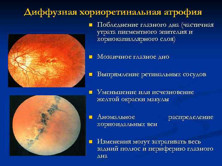 Хориоретинальная дегенерация