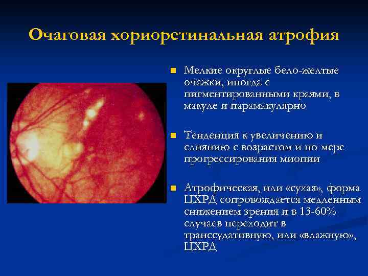 Очаговая хориоретинальная атрофия n Мелкие округлые бело-желтые очажки, иногда с пигментированными краями, в макуле