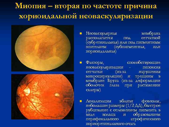 Миопия – вторая по частоте причина хориоидальной неоваскуляризации n Неоваскулярная мембрана располагается под сетчаткой