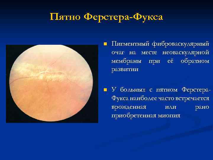 Пятно Ферстера-Фукса n Пигментный фиброваскулярный очаг на месте неоваскулярной мембраны при её обратном развитии