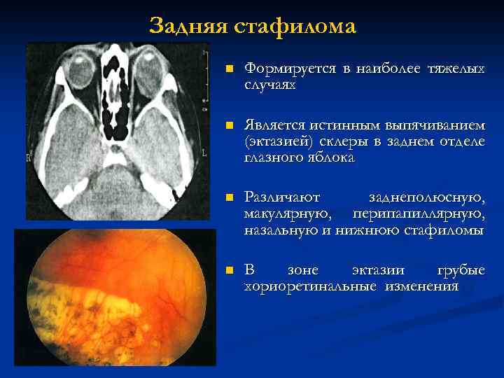 Задняя стафилома n Формируется в наиболее тяжелых случаях n Является истинным выпячиванием (эктазией) склеры