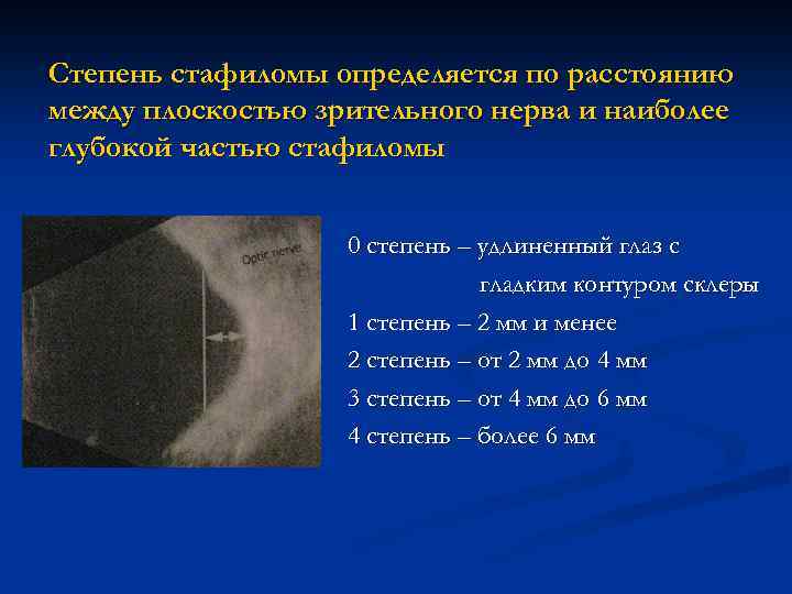 Степень стафиломы определяется по расстоянию между плоскостью зрительного нерва и наиболее глубокой частью стафиломы