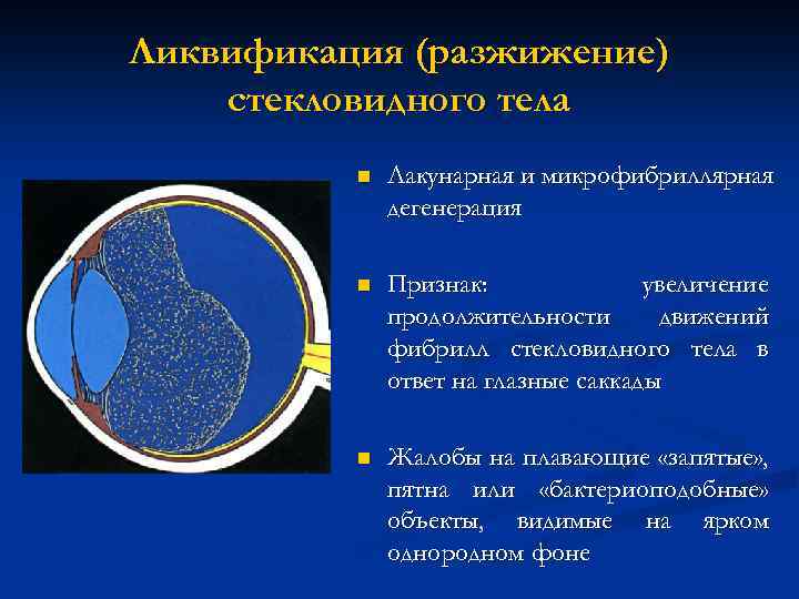 Ликвификация (разжижение) стекловидного тела n Лакунарная и микрофибриллярная дегенерация n Признак: увеличение продолжительности движений