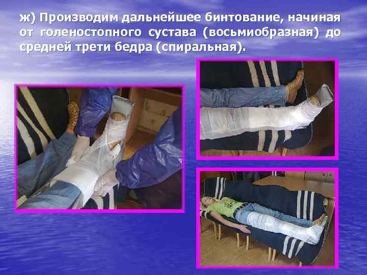 ж) Производим дальнейшее бинтование, начиная от голеностопного сустава (восьмиобразная) до средней трети бедра (спиральная).