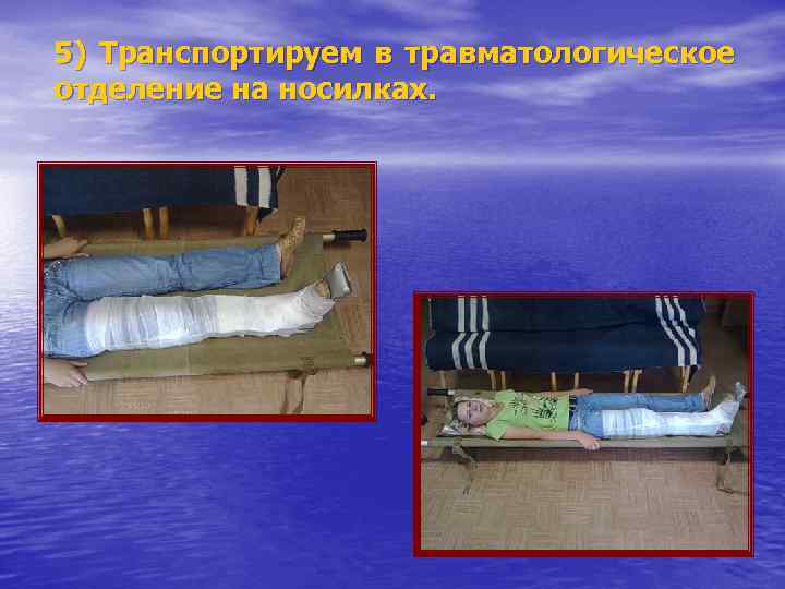 5) Транспортируем в травматологическое отделение на носилках. 
