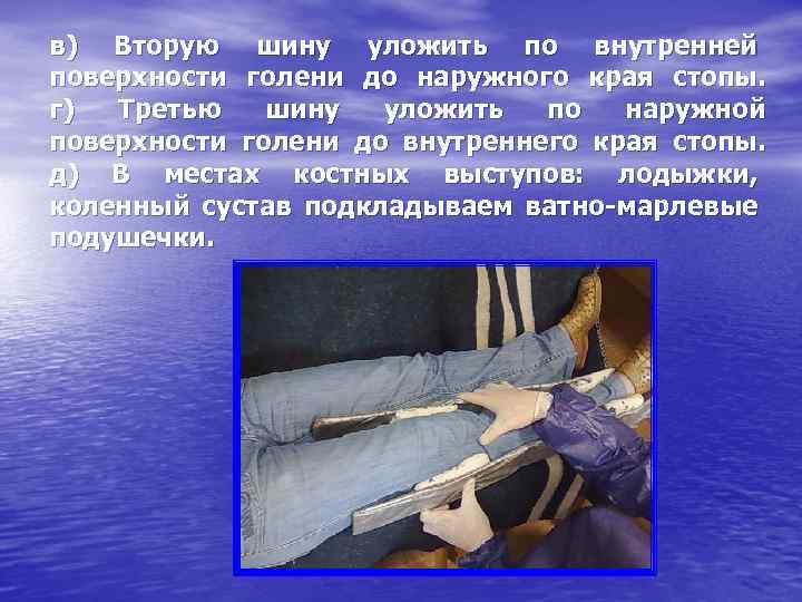 в) Вторую шину уложить по внутренней поверхности голени до наружного края стопы. г) Третью