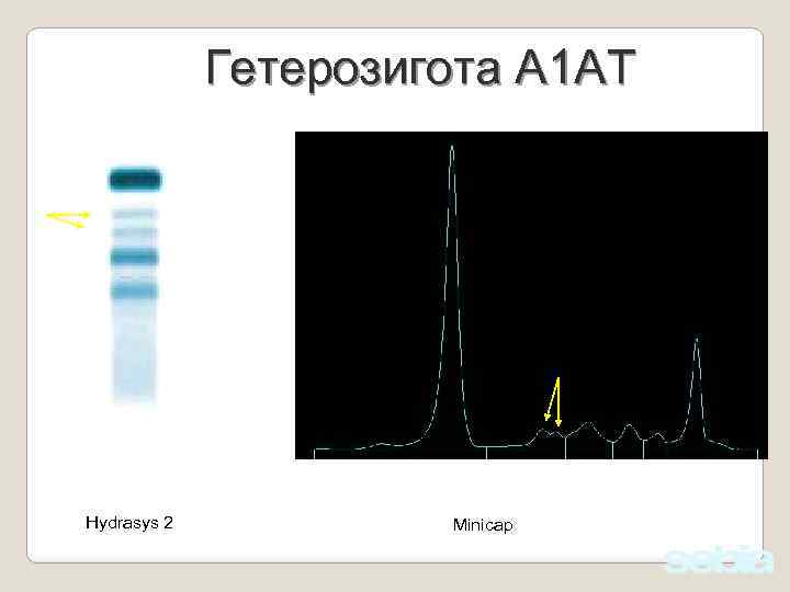 Гетерозигота А 1 АТ Hydrasys 2 Minicap 