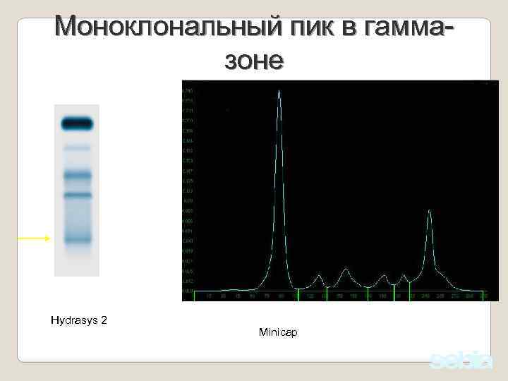 Моноклональный пик в гаммазоне Детектор Hydrasys 2 Minicap 