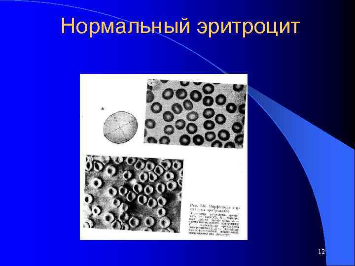 Нормальный эритроцит 12 