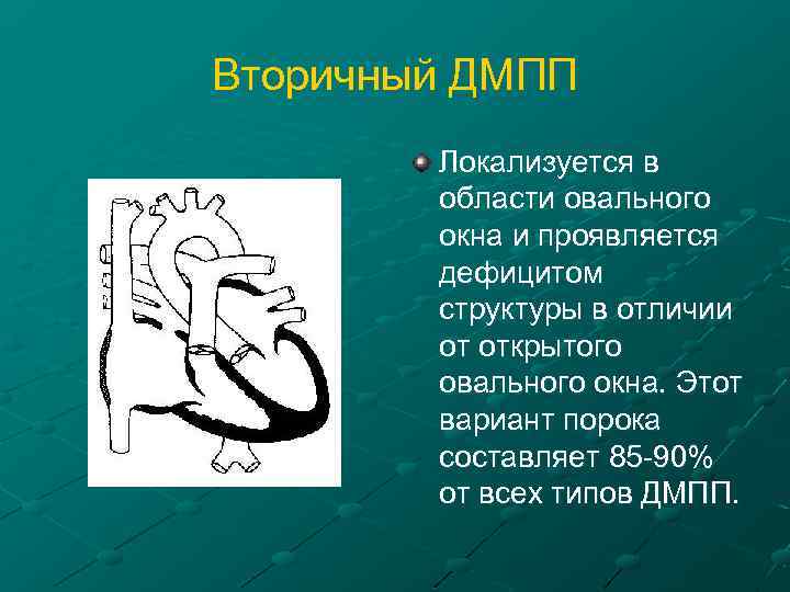 Вторичный ДМПП Локализуется в области овального окна и проявляется дефицитом структуры в отличии от