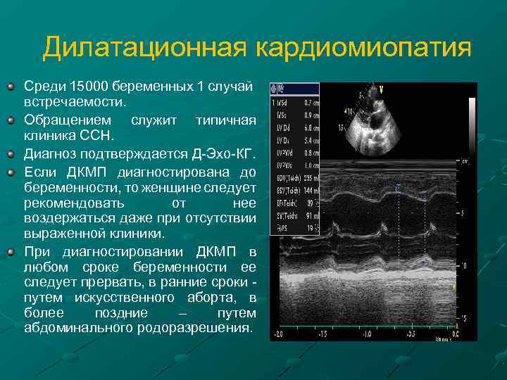  Дилатационная кардиомиопатия Среди 15000 беременных 1 случай встречаемости. Обращением служит типичная клиника ССН.