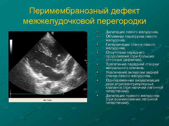 Перимембранозный дефект межжелудочковой перегородки Дилатация левого желудочка. Объемная перегрузка левого желудочка. Гиперкинезия стенок левого