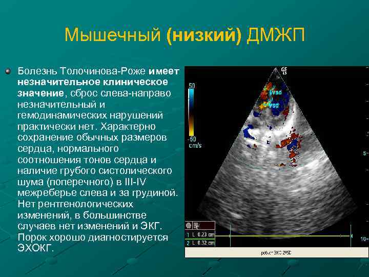 Мышечный (низкий) ДМЖП Болезнь Толочинова-Роже имеет незначительное клиническое значение, сброс слева-направо незначительный и гемодинамических