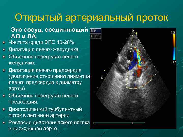 Открытый артериальный проток Это сосуд, соединяющий АО и ЛА. Частота среди ВПС 10 -20%.