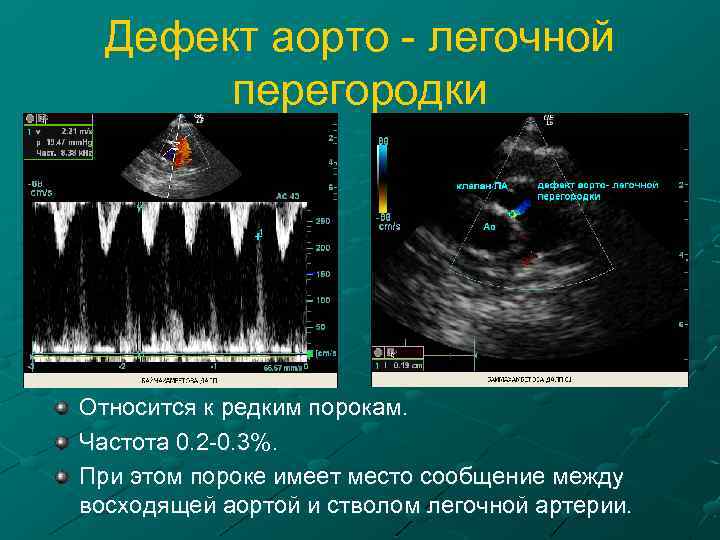 Дефект аорто - легочной перегородки Относится к редким порокам. Частота 0. 2 -0. 3%.