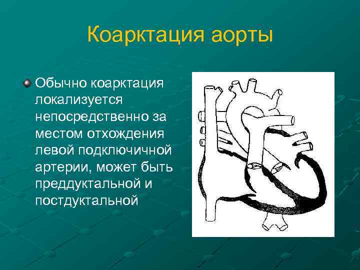 Коарктация аорты Обычно коарктация локализуется непосредственно за местом отхождения левой подключичной артерии, может быть