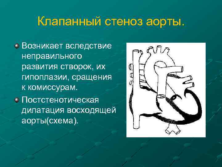 Клапанный стеноз аорты. Возникает вследствие неправильного развития створок, их гипоплазии, сращения к комиссурам. Постстенотическая