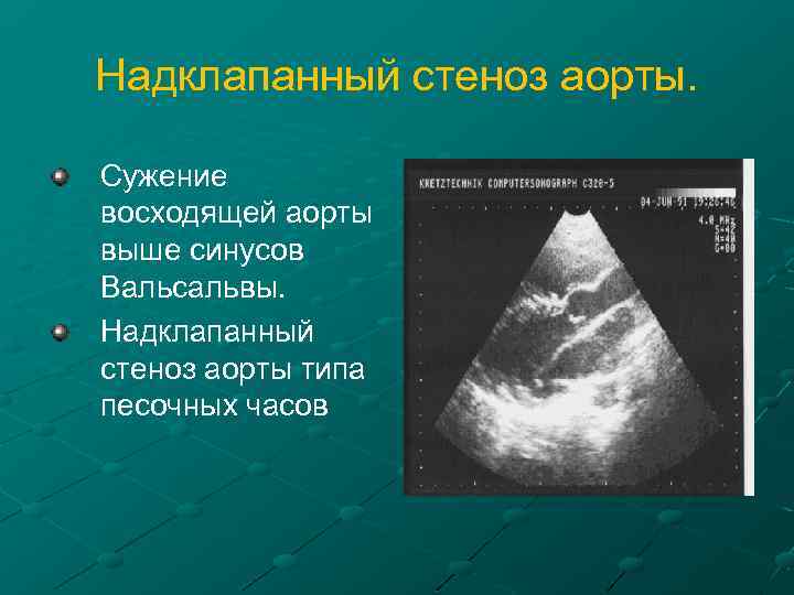 Надклапанный стеноз аорты. Сужение восходящей аорты выше синусов Вальсальвы. Надклапанный стеноз аорты типа песочных