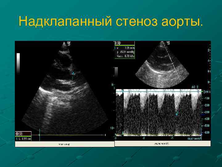 Надклапанный стеноз аорты. 