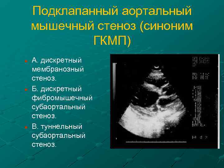 Подклапанный аортальный мышечный стеноз (синоним ГКМП) n n n А. дискретный мембранозный стеноз. Б.