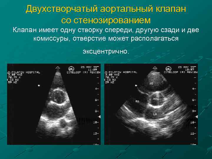 Двухстворчатый аортальный клапан со стенозированием Клапан имеет одну створку спереди, другую сзади и две