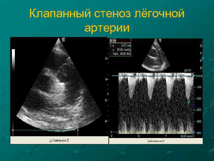 Клапанный стеноз лёгочной артерии 