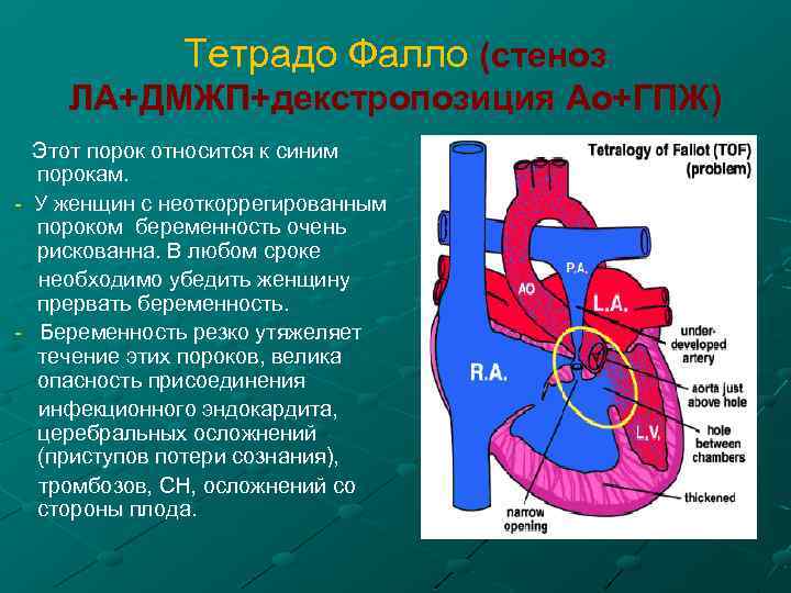 Тетрадо Фалло (стеноз ЛА+ДМЖП+декстропозиция Ао+ГПЖ) Этот порок относится к синим порокам. - У женщин