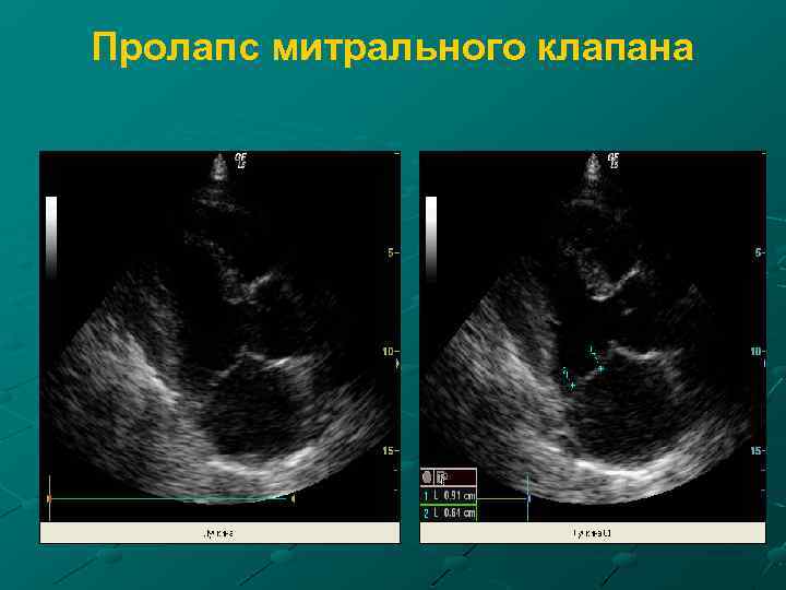 Пролапс митрального клапана 