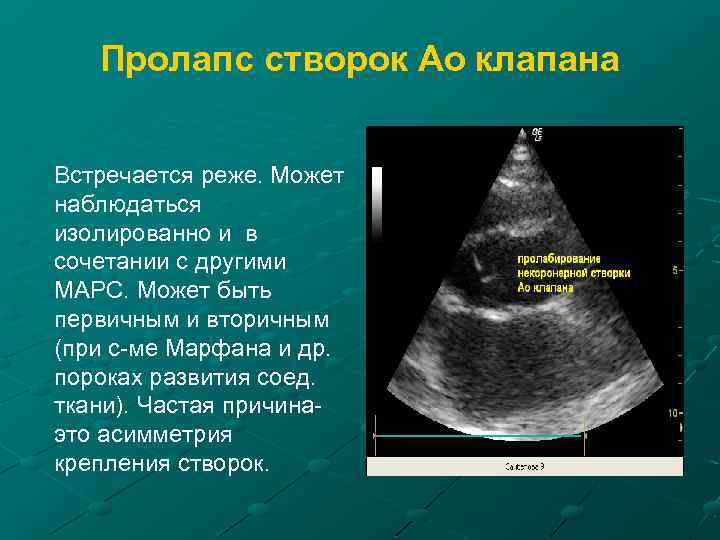 Пролапс створок Ао клапана Встречается реже. Может наблюдаться изолированно и в сочетании с другими