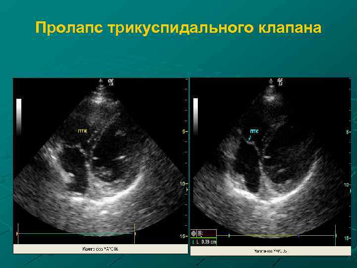 Пролапс трикуспидального клапана 