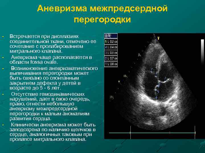 Аневризма межпредсердной перегородки - - Встречается при дисплазиях соединительной ткани, отмечено ее сочетание с