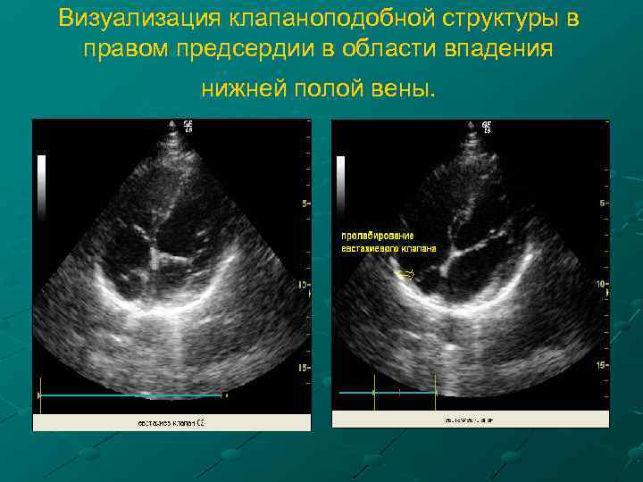 Визуализация клапаноподобной структуры в правом предсердии в области впадения нижней полой вены. 