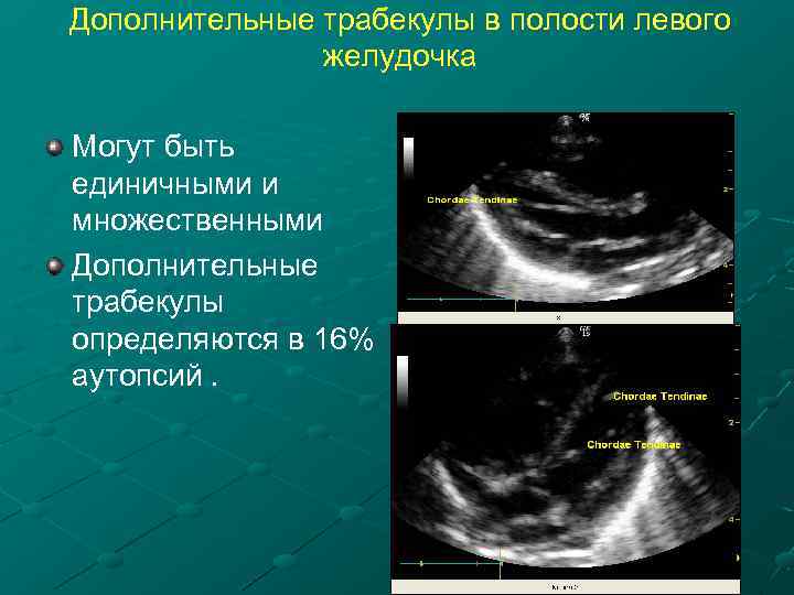 Дополнительные трабекулы в полости левого желудочка Могут быть единичными и множественными Дополнительные трабекулы определяются