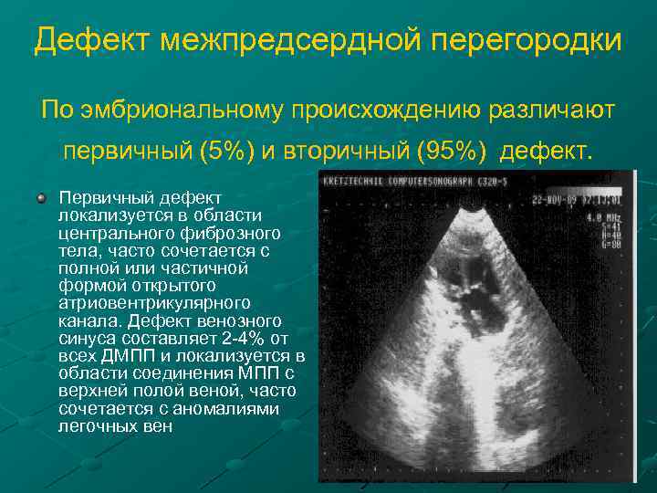 Дефект межпредсердной перегородки По эмбриональному происхождению различают первичный (5%) и вторичный (95%) дефект. Первичный