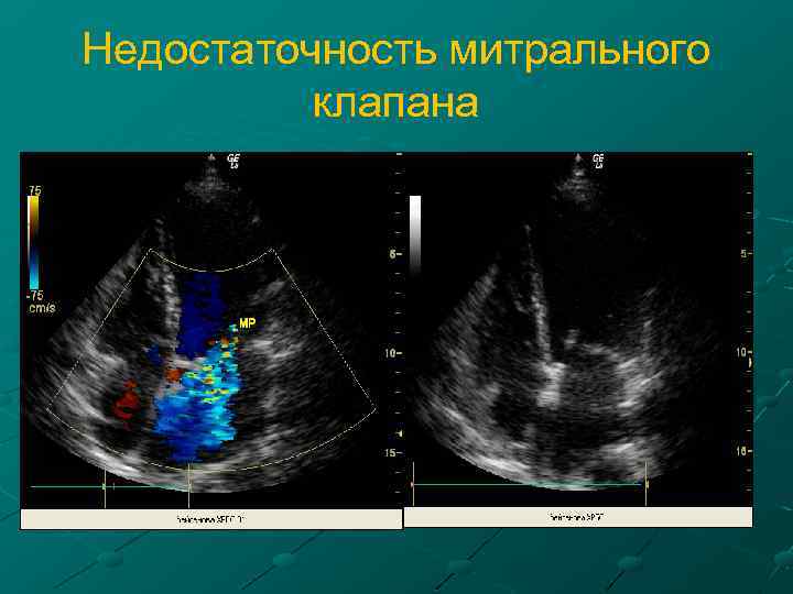 Недостаточность митрального клапана 