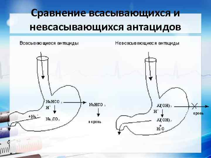 Сравнение всасывающихся и невсасывающихся антацидов 