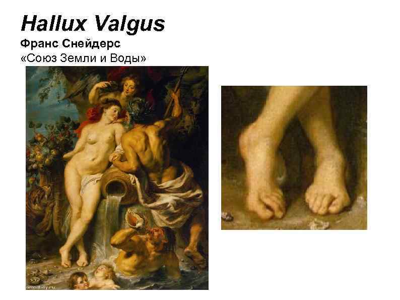 Hallux Valgus Франс Снейдерс «Союз Земли и Воды» 