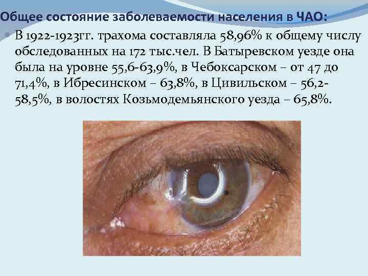 Общее состояние заболеваемости населения в ЧАО: В 1922 -1923 гг. трахома составляла 58, 96%