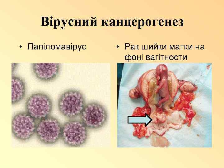 Вірусний канцерогенез • Папіломавірус • Рак шийки матки на фоні вагітности 