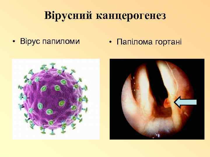 Вірусний канцерогенез • Вірус папиломи • Папілома гортані 