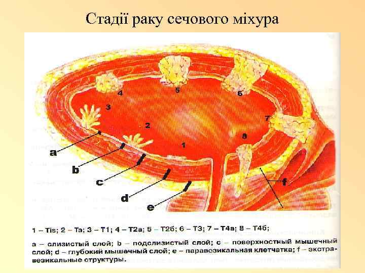 Стадії раку сечового міхура 