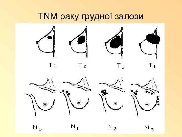 TNM раку грудної залози 